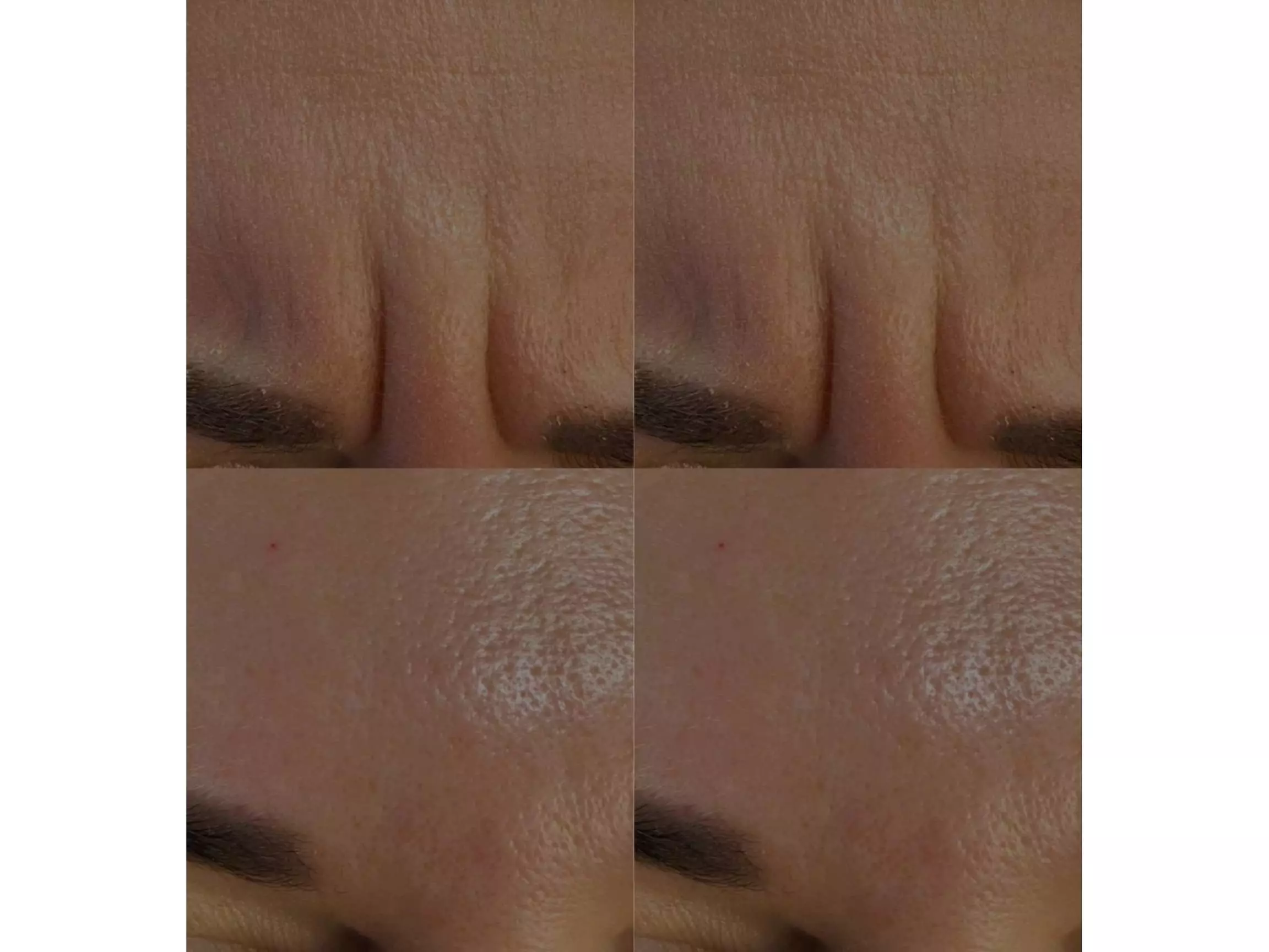 Refresh Your Look with Expert Dysport Injections