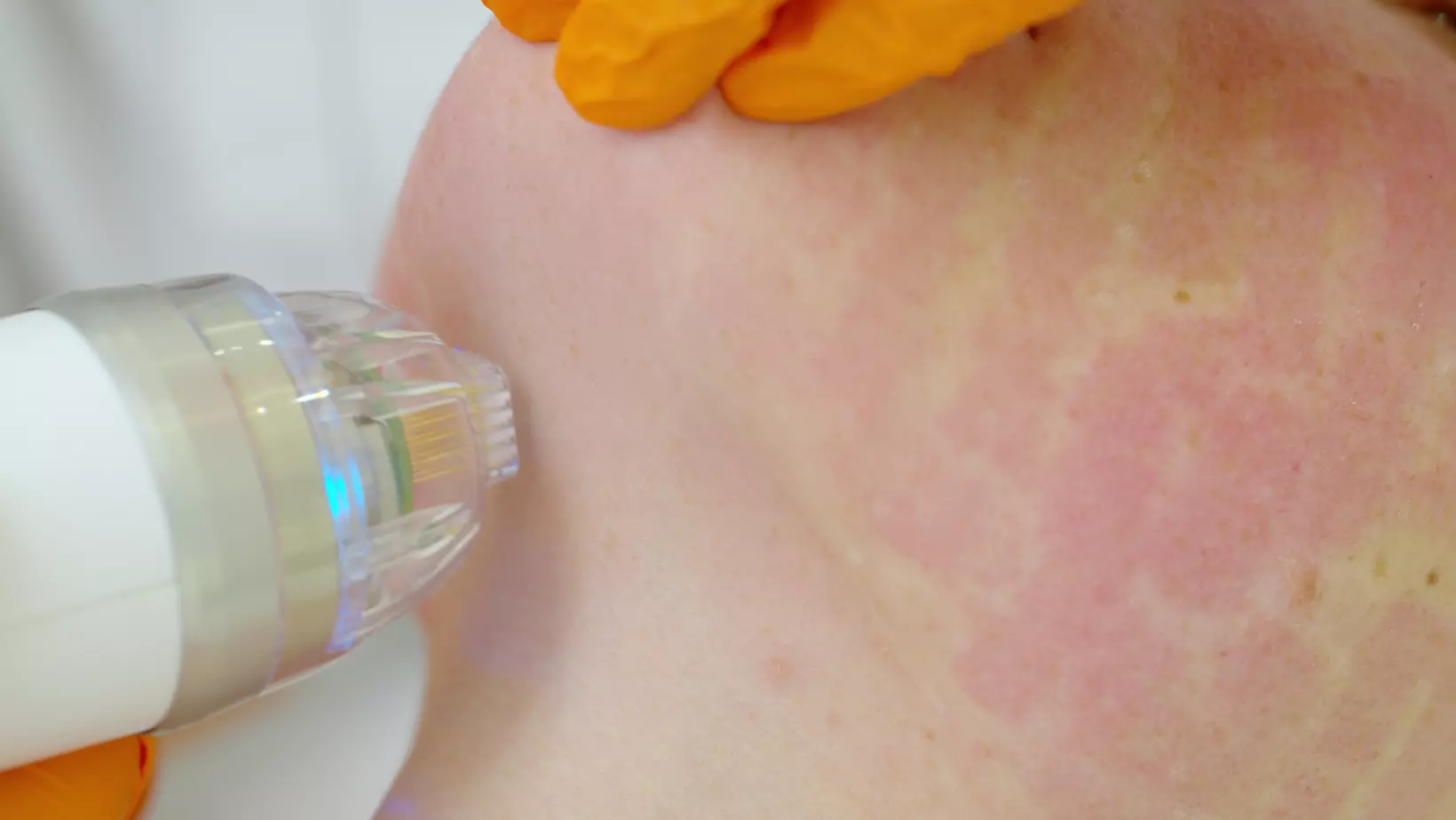 Up to 48% Off on Micro-Needling at Aurora Medical Tampa - Second Medium