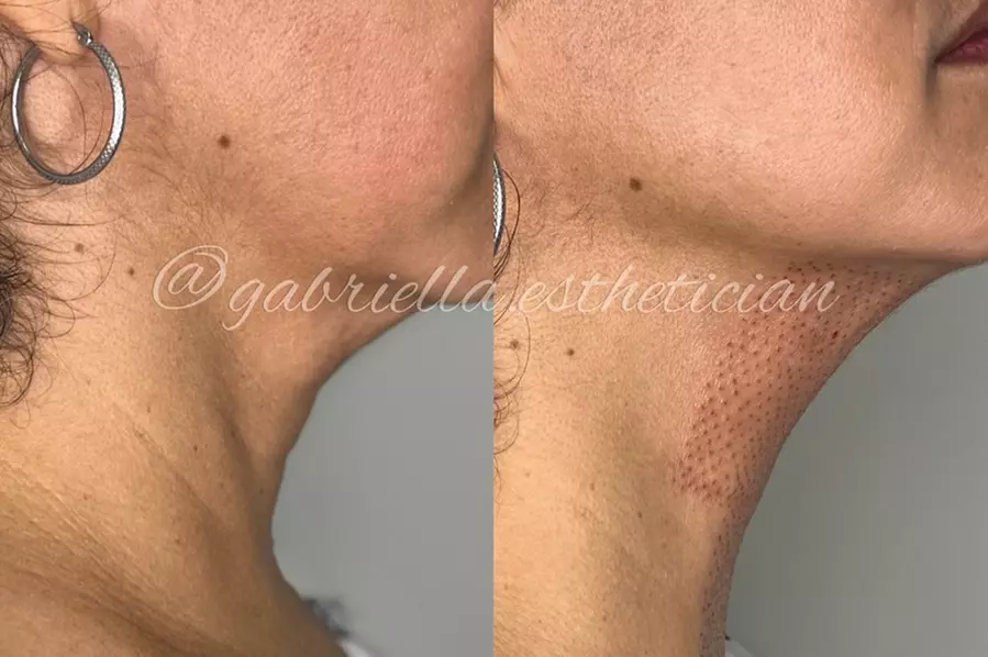 Fibroblast Plasma Pen Lifts for Face and Neck