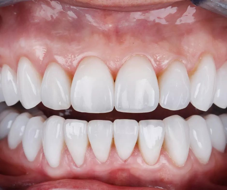 Experience Brite Smile teeth whitening at Superior Next Generation Spa with options up to 50% off for stunning results. - Second Medium