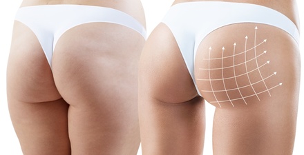 One 60-Minute Body Contouring & Brazilian Booty Lift and Consultation