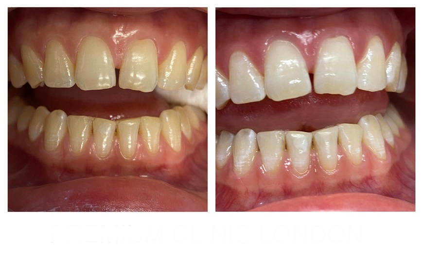 Image 5: Brighten Your Smile with A Laser Teeth Whitening Treatment