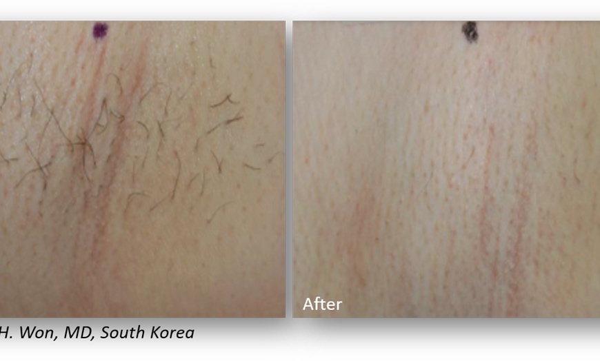 Image 5: Up to 63% Off on Laser Hair Removal at New Moon Aesthetics