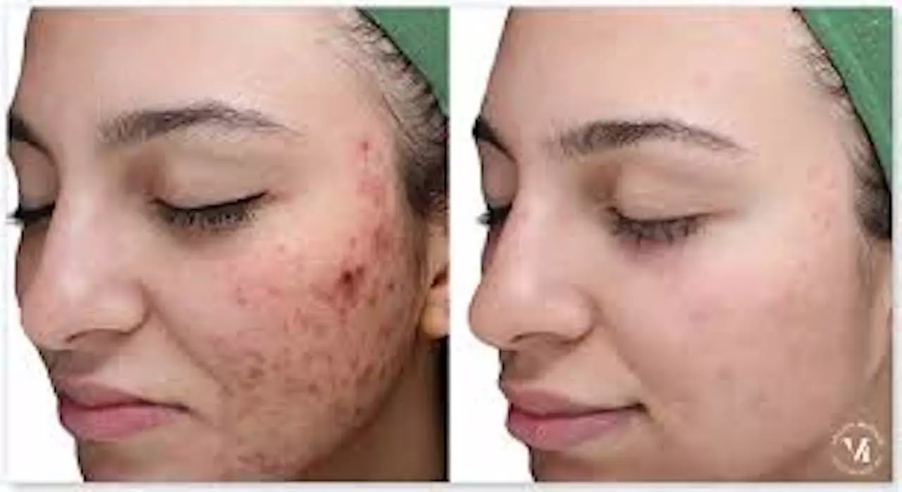 Up to 26% Off on Chemical Peel at Modernized Wellness - Primary Image