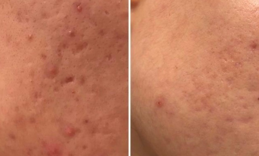 Image 4: Up to 63% Off on Micro-Needling at Aesthetics Care Med Spa