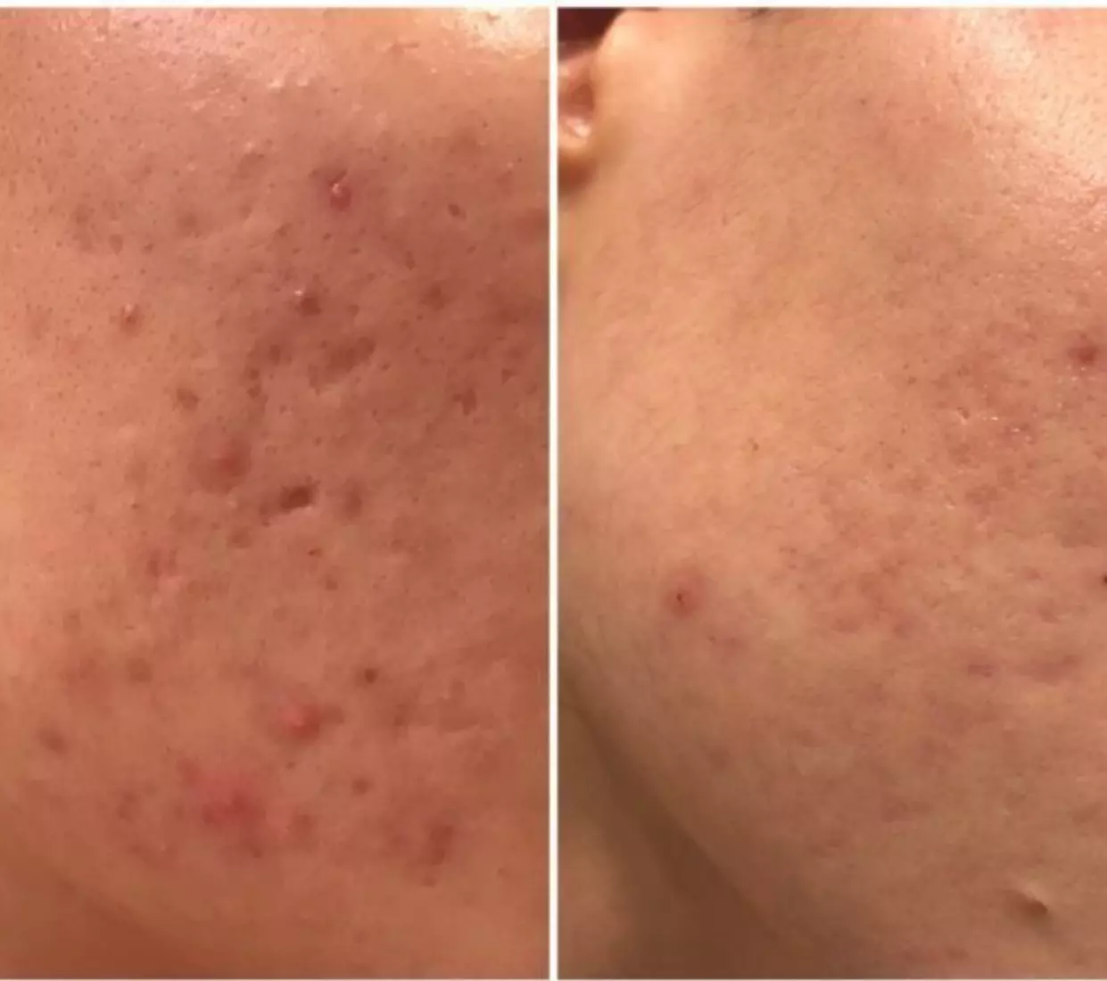 Up to 78% Off on Micro-Needling at Aesthetics Care Med Spa
