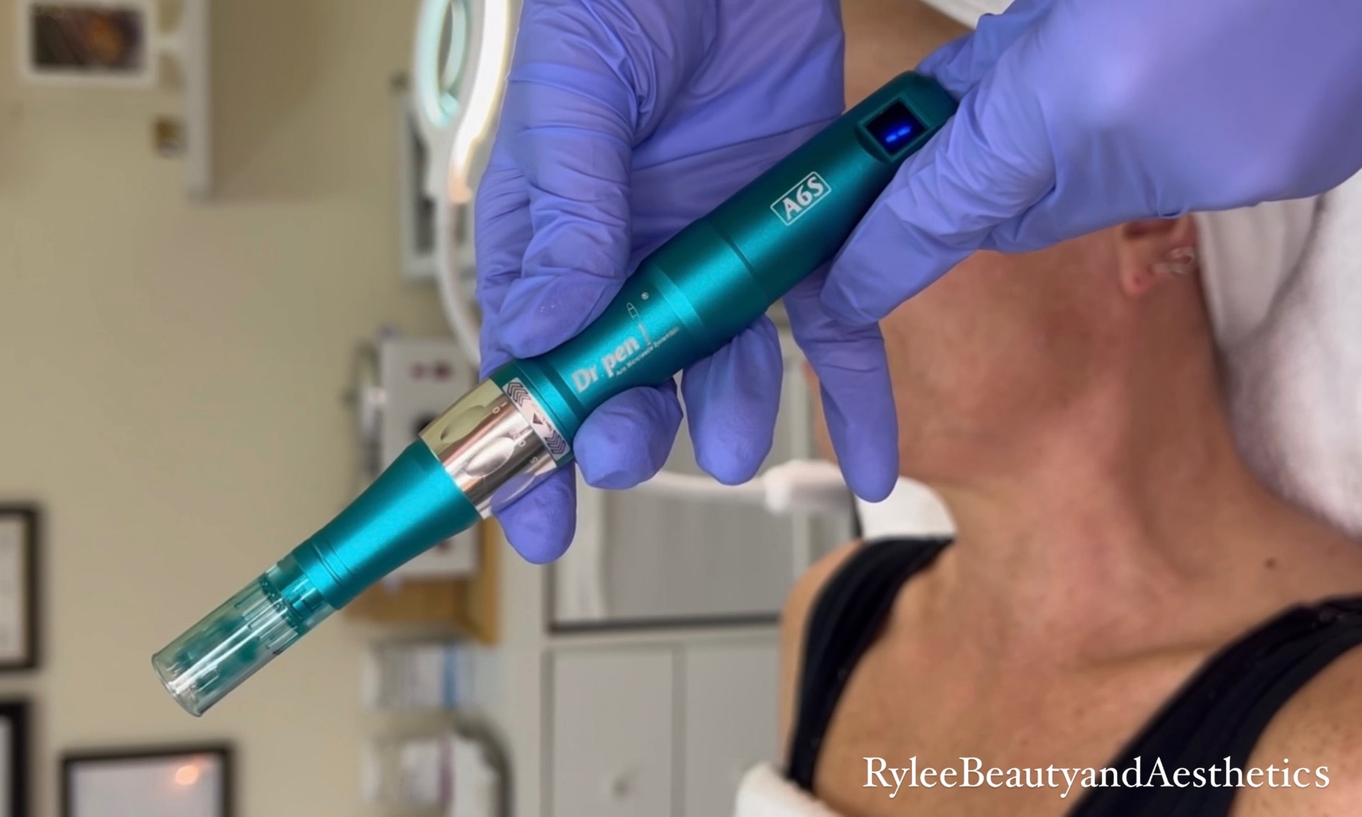 Microneedling treatment with optional chemical peel included