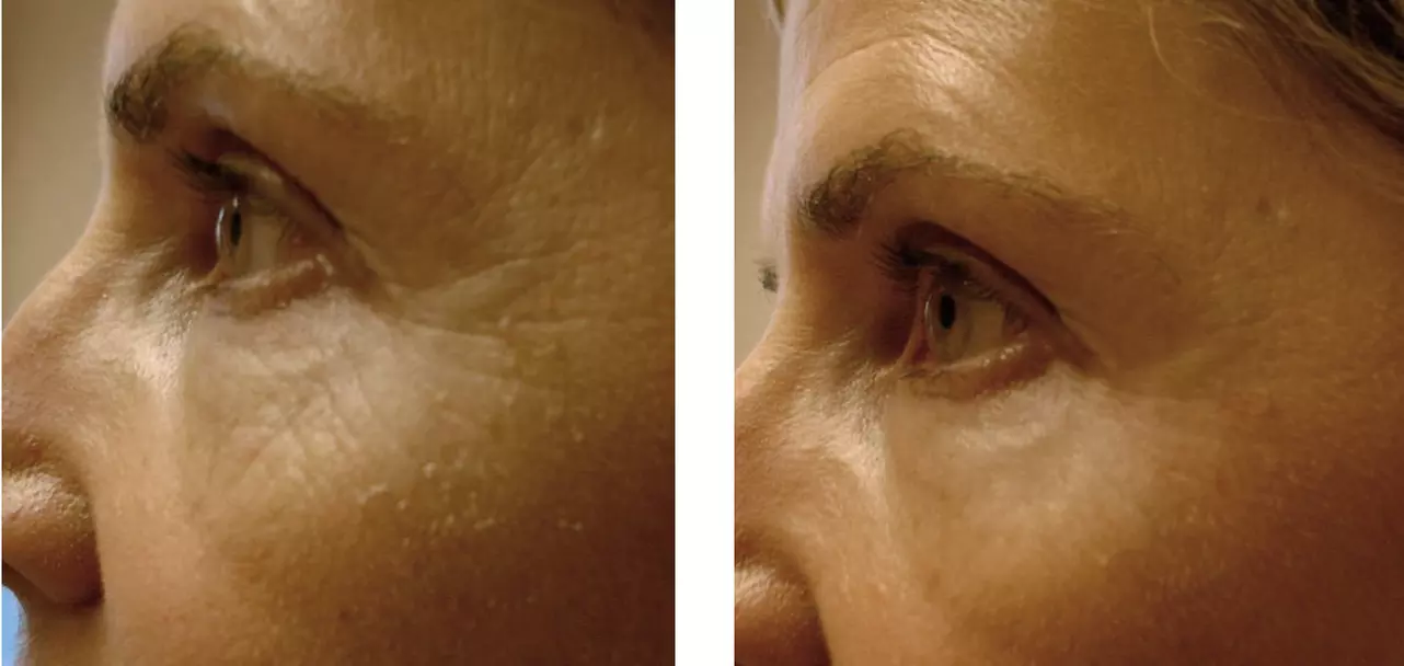 NanoFusion Facial: Needle Free Micro Needling & Collagen Mask