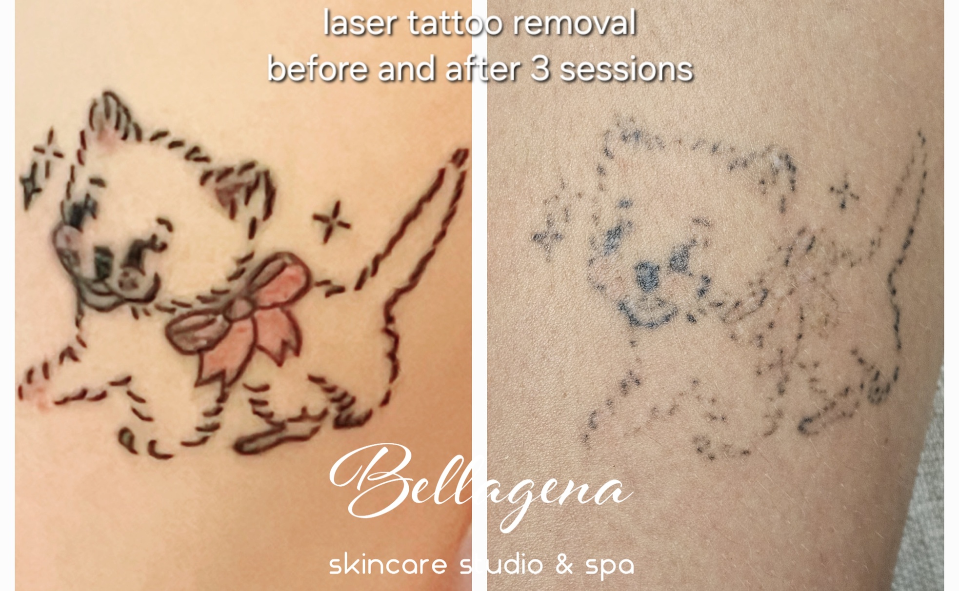 Bellagena Offers Three Laser Tattoo Removal Sessions for Small, X-Small, or XX-Small Areas (Up to 56% Off) - Primary Image