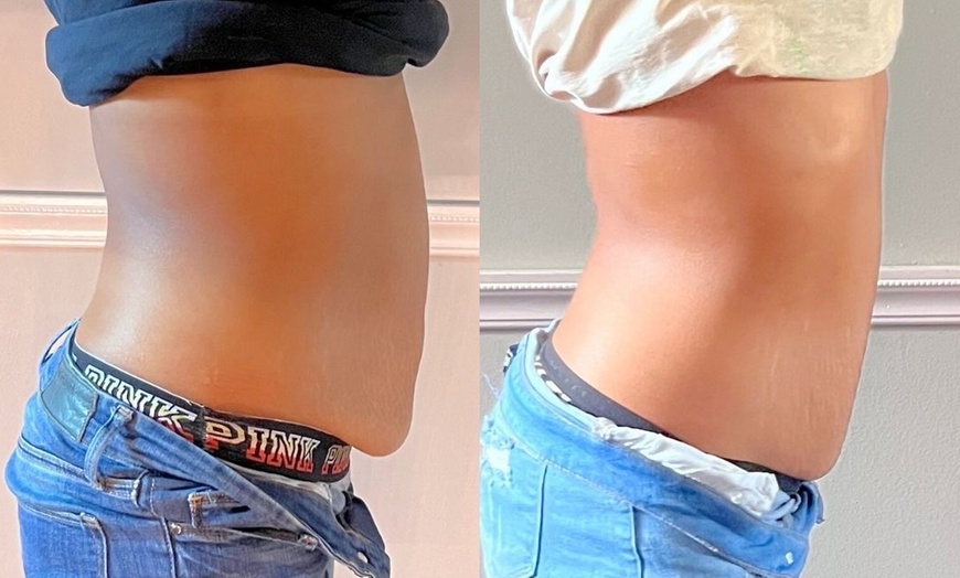 Image 2: Up to 50% Off on Fat Reduction - Non-Branded at Bodiology Esthetic and Contouring