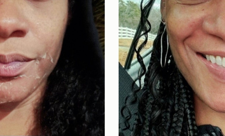 Image 1: Revitalize Your Skin with Chemical Peel Treatments