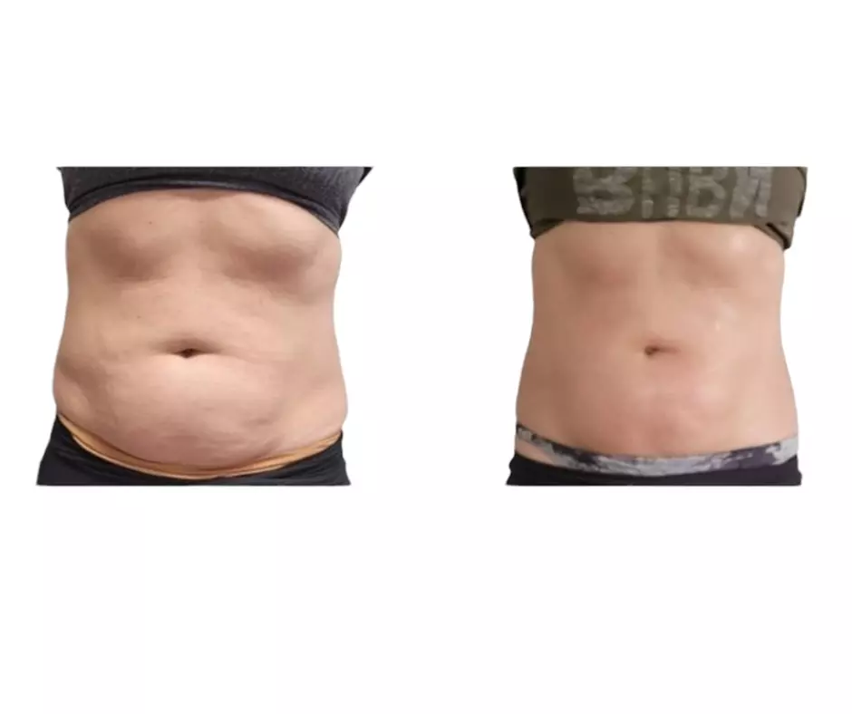 Experience Body Contour & Spa's Laser-Lipo Sessions, reducing inches up to 66% with cutting-edge technology - Primary Image