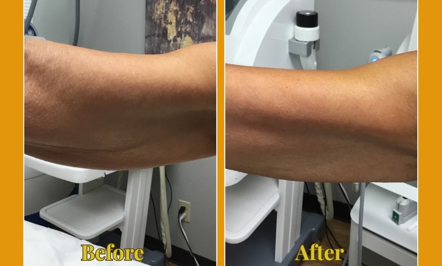 Image 7: Ultherapy Prime Treatment with for Face, Neck and Chest 