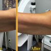 Image 7: Ultherapy Prime Treatment with for Face, Neck and Chest 