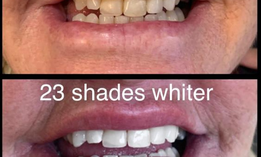 Image 2: Up to 64% Off on Teeth Whitening - Traditional at Better bodies