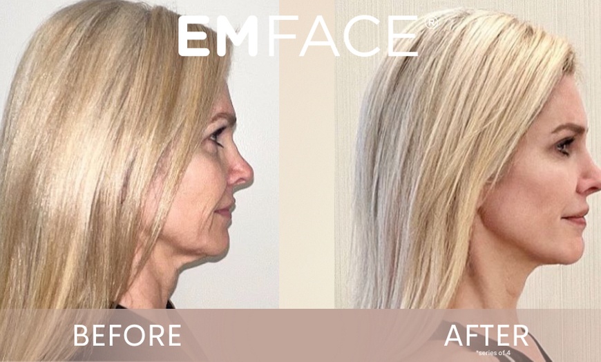 Image 2: Up to 37% Off on Facelift - Non-Surgical at Total Body Aesthetics