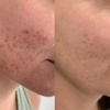 Image 2: One IPL/Photofacial Treatment For Face, with Optional Neck or Chest 