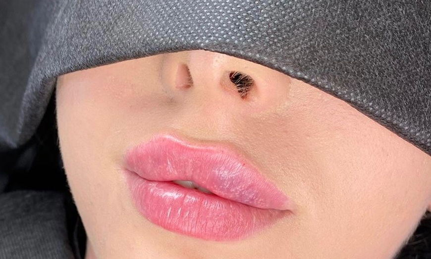 Image 2: Up to 68% Off on Injection - Dermal Filler at Queen of Lips