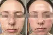 Up to 40% Off on Chemical Peel at Rise Skin Spa - Second Medium