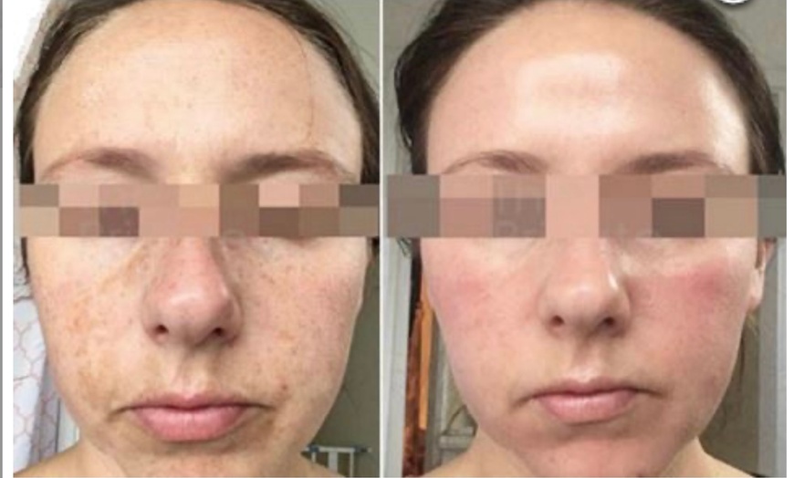 Image 2: Advanced Chemical Peel or 2-Hour Anti-Aging Facial at RISE Skin Spa