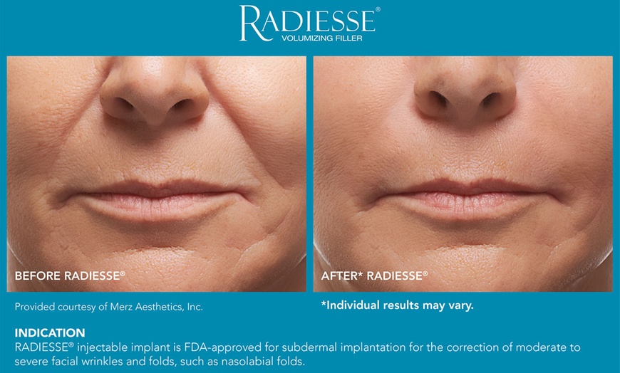 Image 4: Revitalize Skin's Youthful Glow with One Syringe of Radiesse Filler