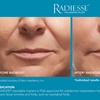 Image 4: Revitalize Skin's Youthful Glow with One Syringe of Radiesse Filler
