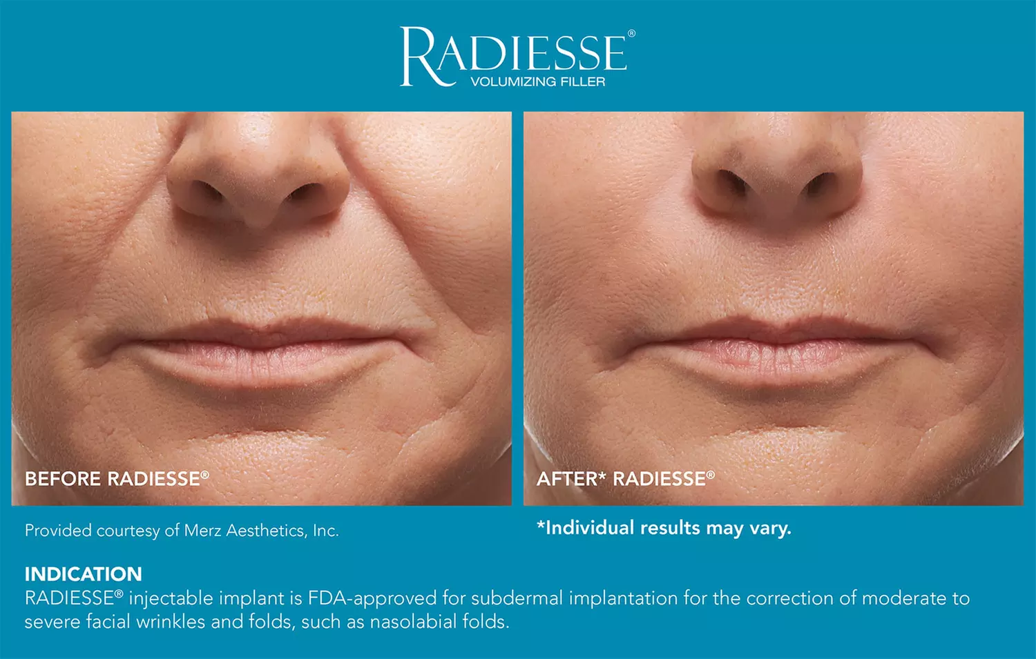 Revitalize Skin's Youthful Glow with One Syringe of Radiesse Filler