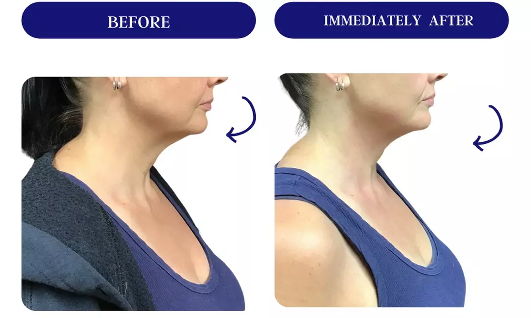 Up to 67% Off on Lipo - Invasive Laser - Aqua at Rafael Diaz-Yoserev, MD., FACS - Primary Image