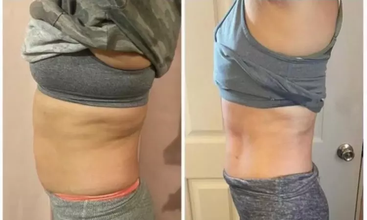 Weight Reduction Program / Center at Pretty Lyfe Esthetics
