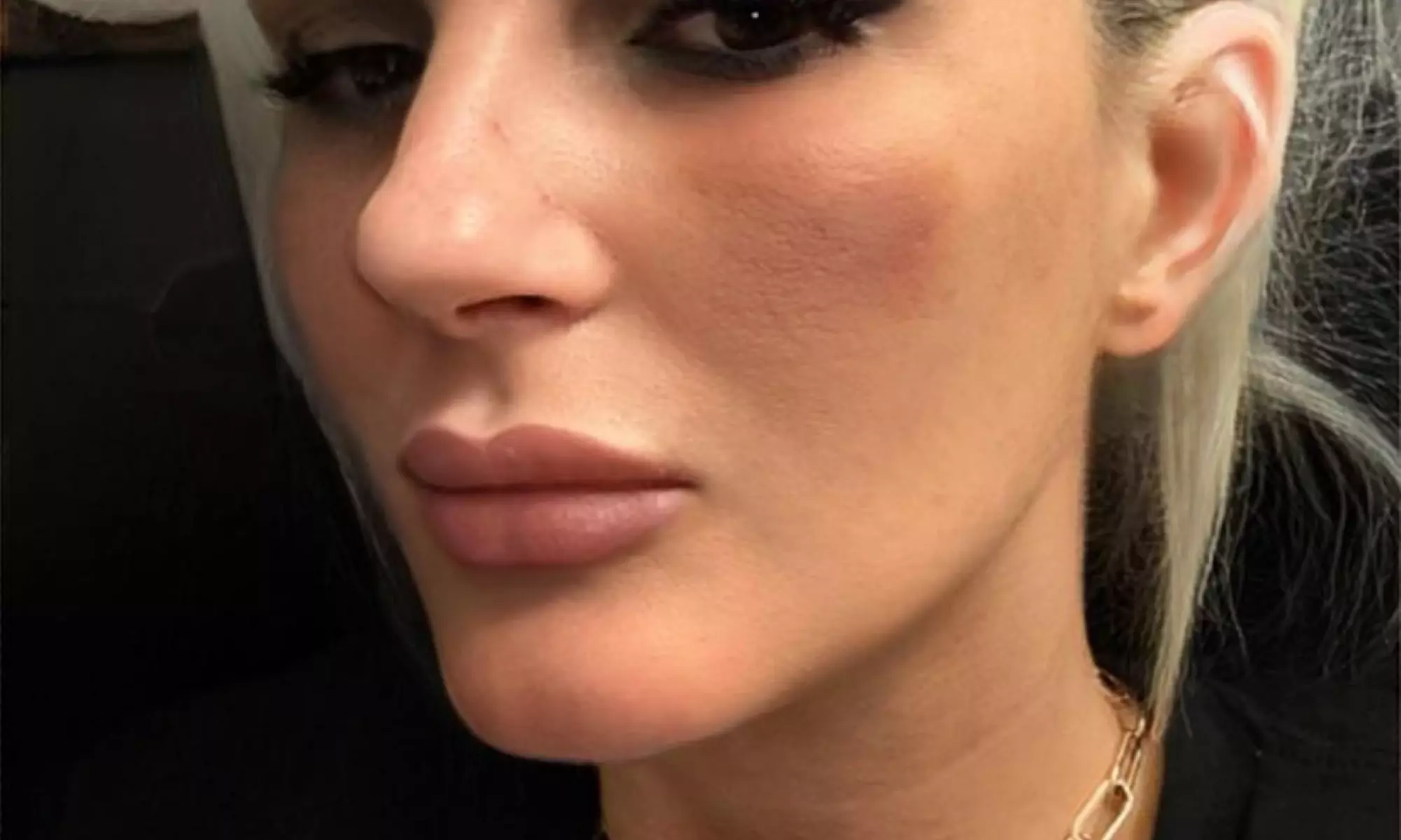 Celebrity-Coveted Cheek Pop or Snatched Jawline with PDO Threads