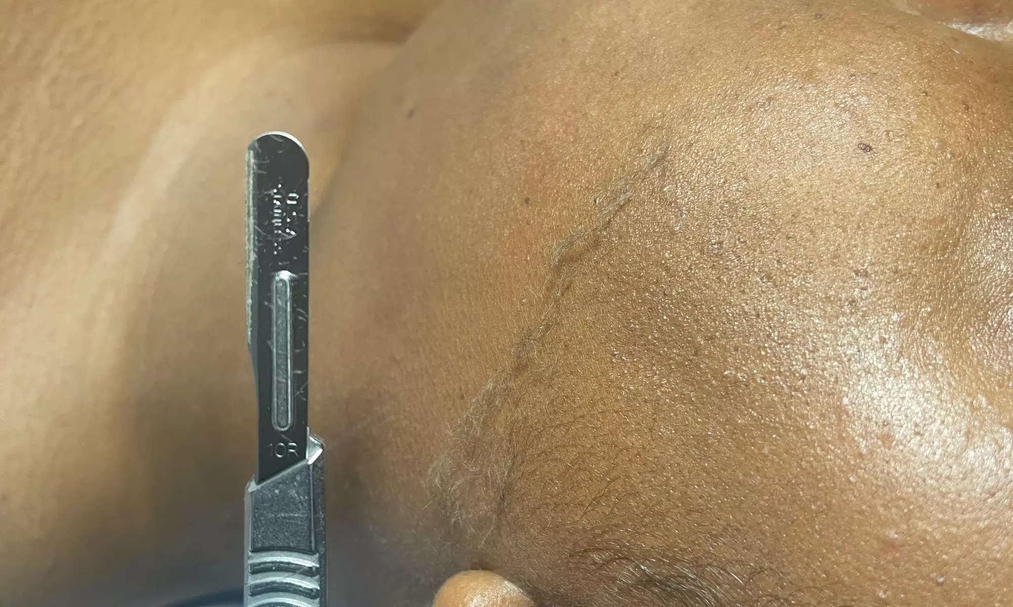 Refresh and Renew with Hydrafacial and Dermaplane Options