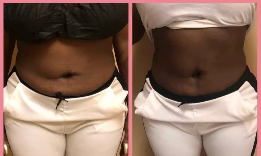 Up to 14% Off Non-Invasive Lipo at Bodied By Simone Llc - Primary Image
