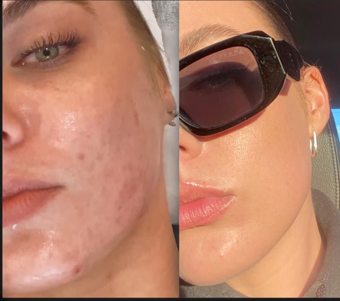 Dermaplane + Hydration or 90-Minute Anti-Aging Treatment with Massage