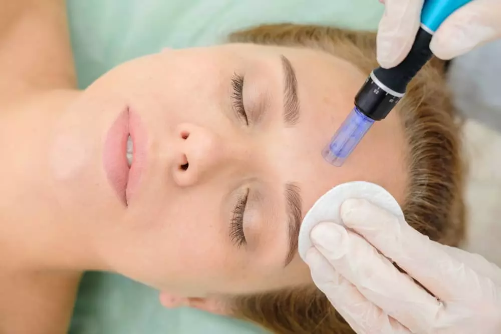 Achieve Youthful Skin: 1 or 3 Microneedling Sessions with Hyaluronic Acid or Vitamins and Get Up to 68% Off - Primary Image