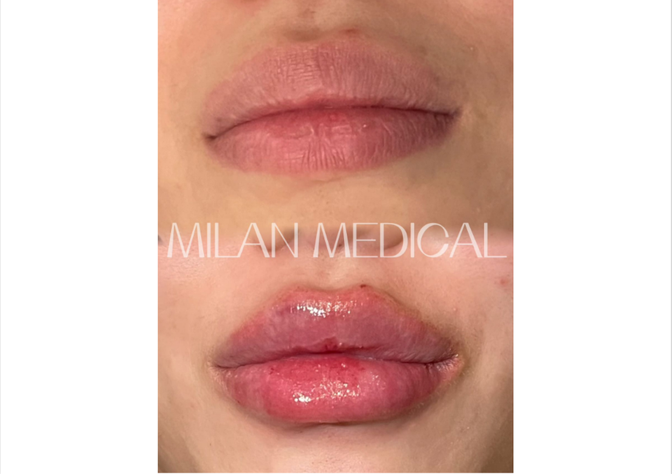 Achieve a Natural Look with Dermal Filler Injections