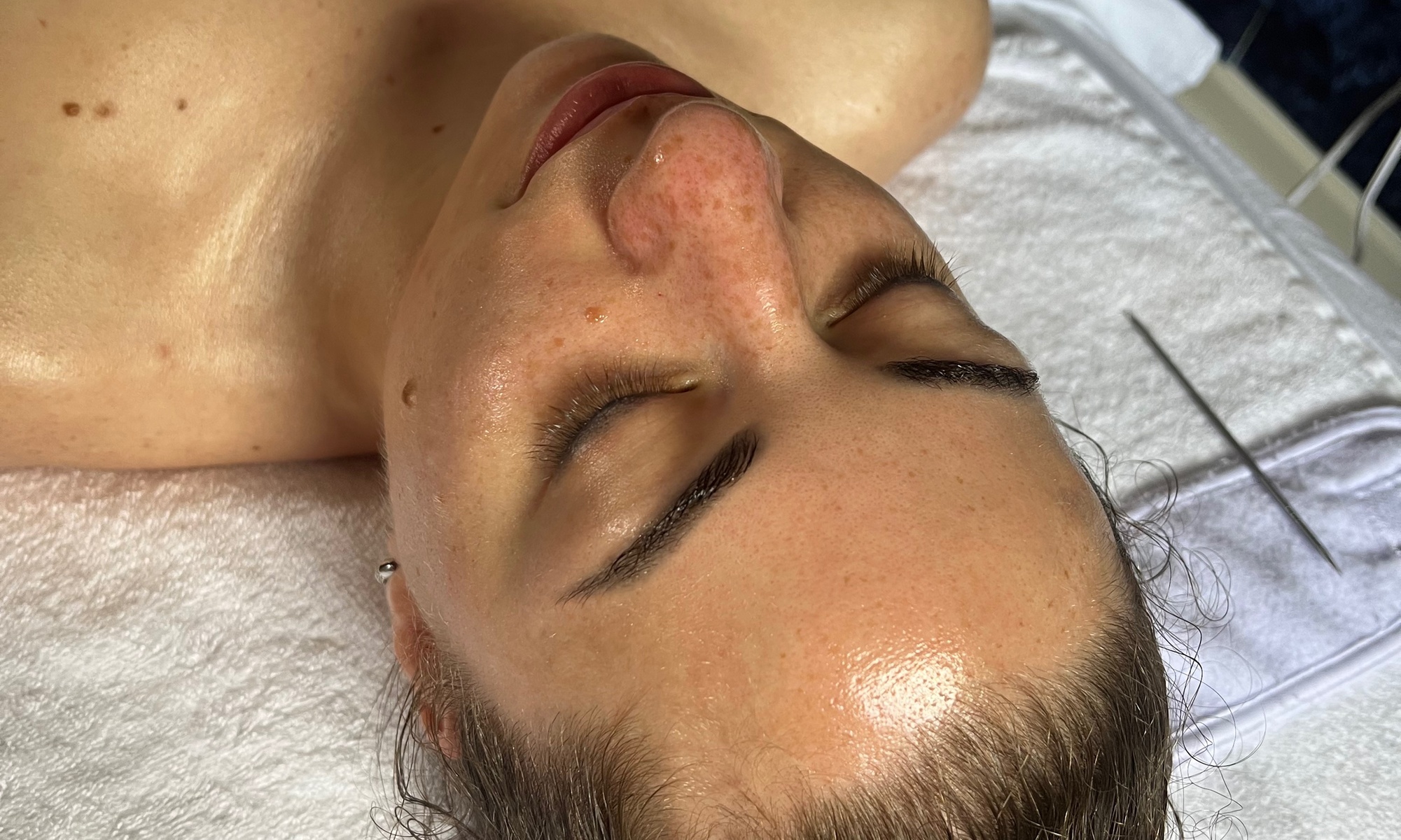 Up to 43% Off on Chemical Peel at Skin Nova Seattle