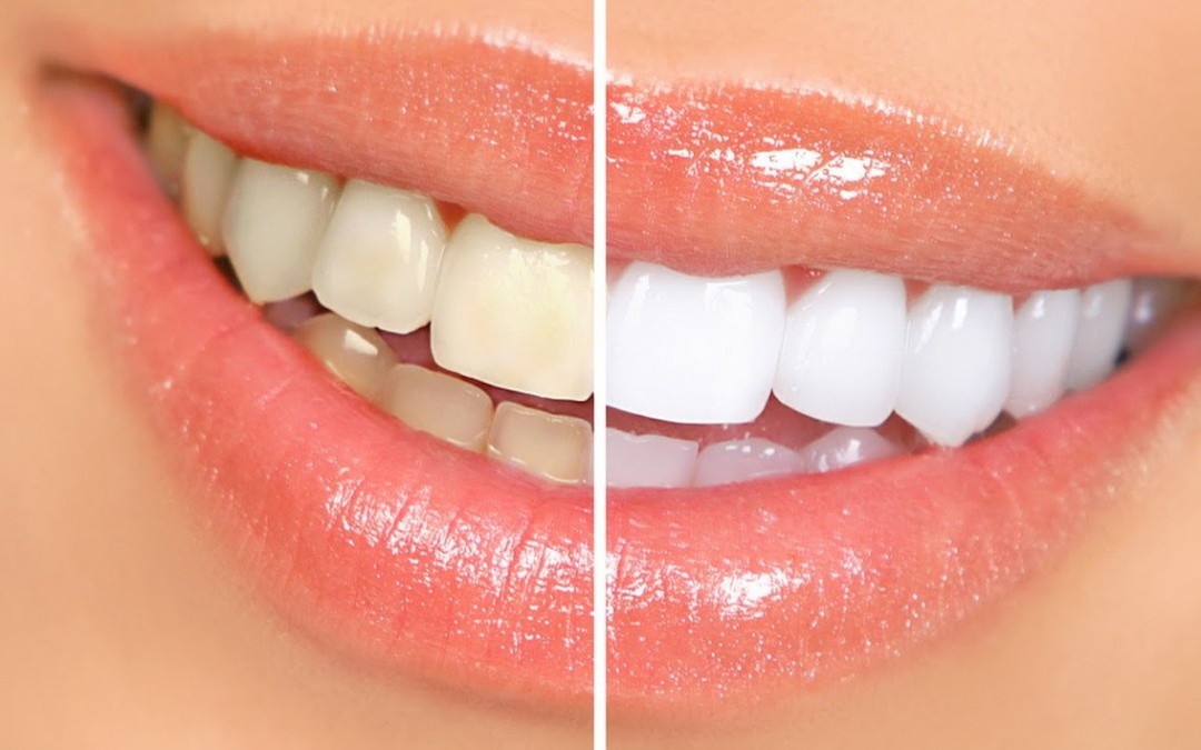 Up to 49% Off on Teeth Whitening - In-Office - Non-Branded at Dental First Care