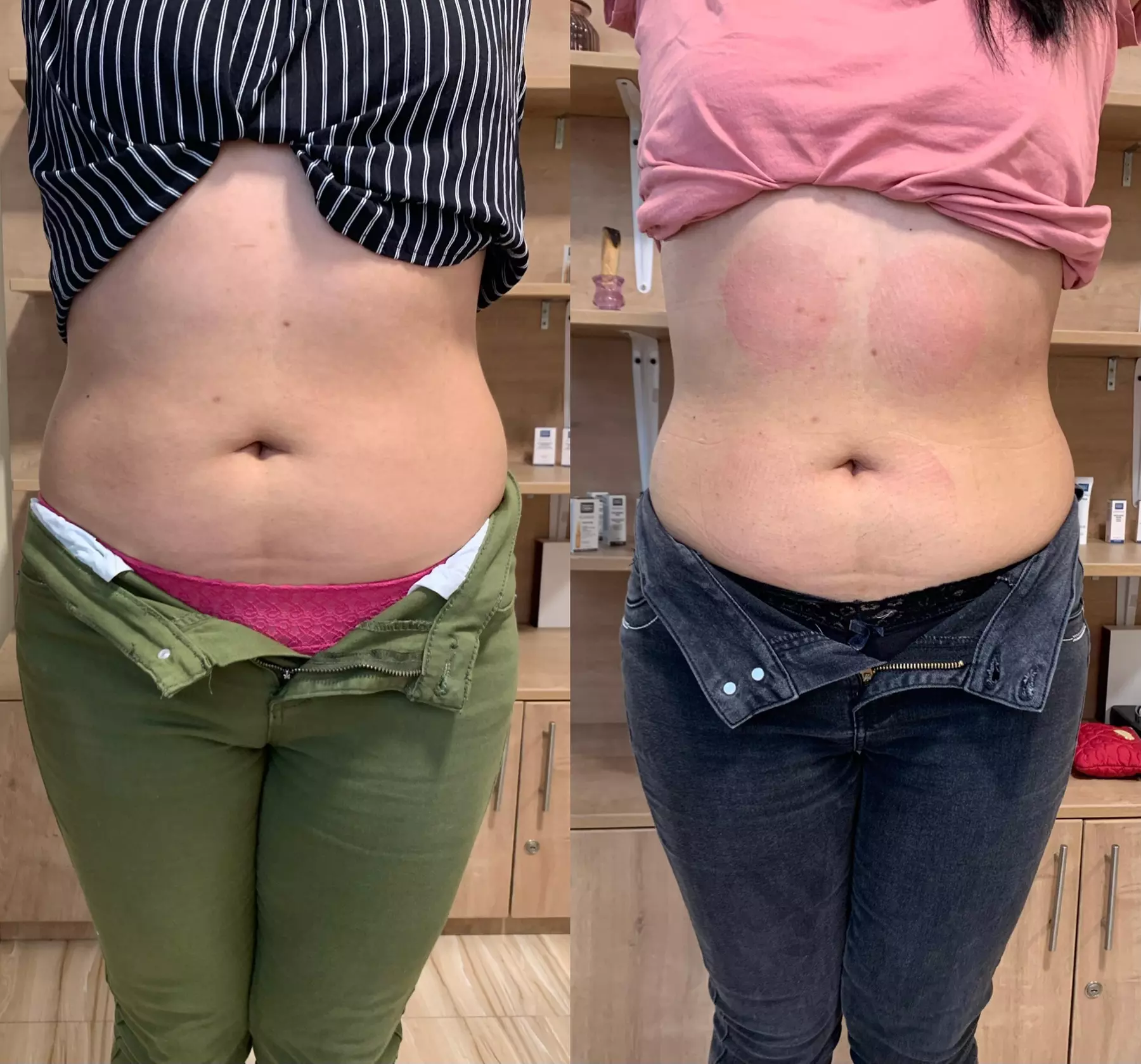 Experience One, Two or Three Cavitation Sessions With RF and EMS