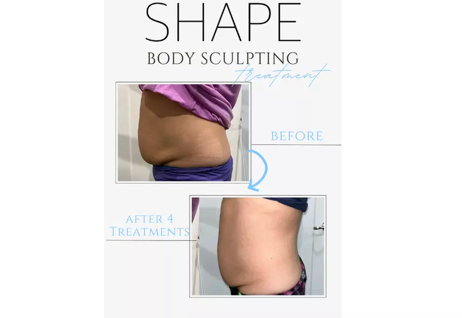 Experience Shape's Fat Freezing Cryo Body Sculpting Packages with savings up to 76% for a transformative body experience - Second Medium