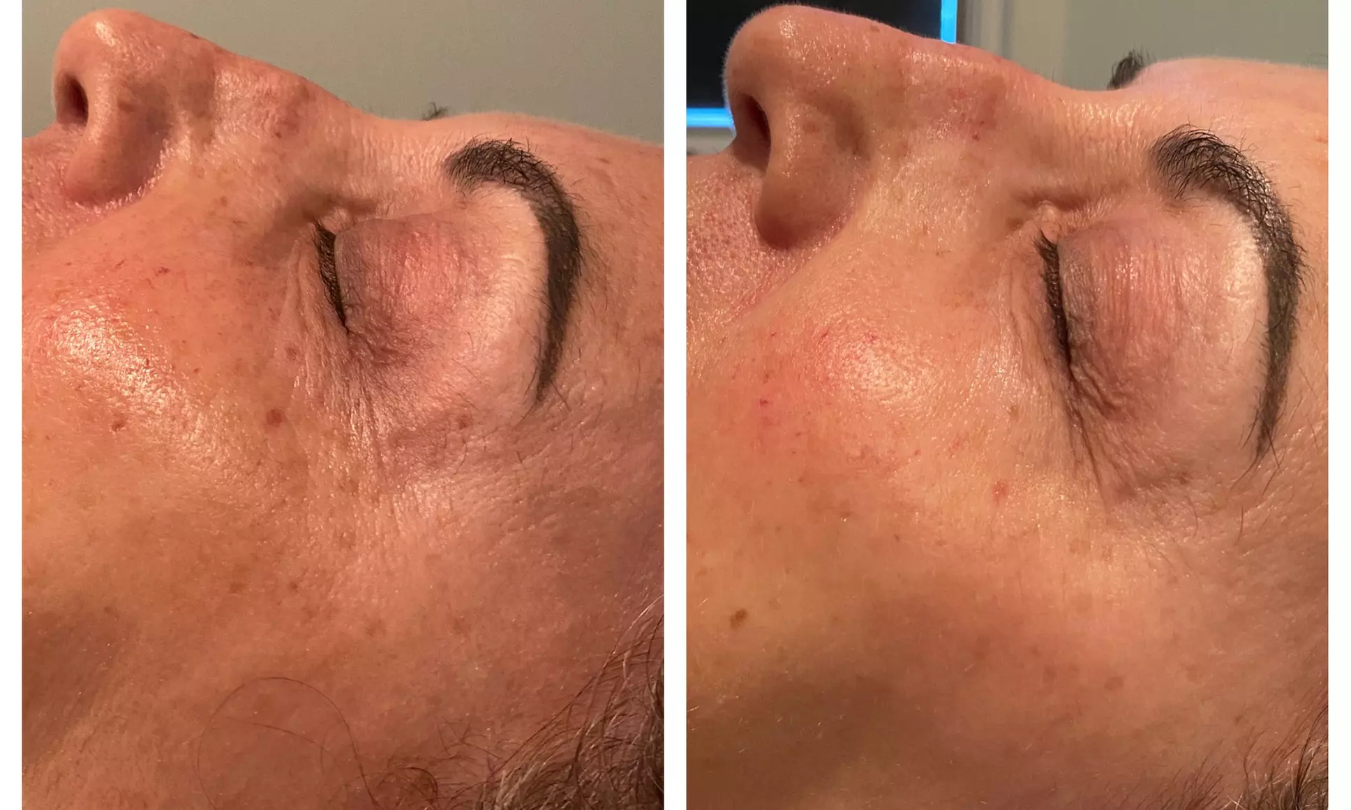 Up to 24% Off on Micro-Needling at DC Aesthetics & Acupuncture - Primary Image