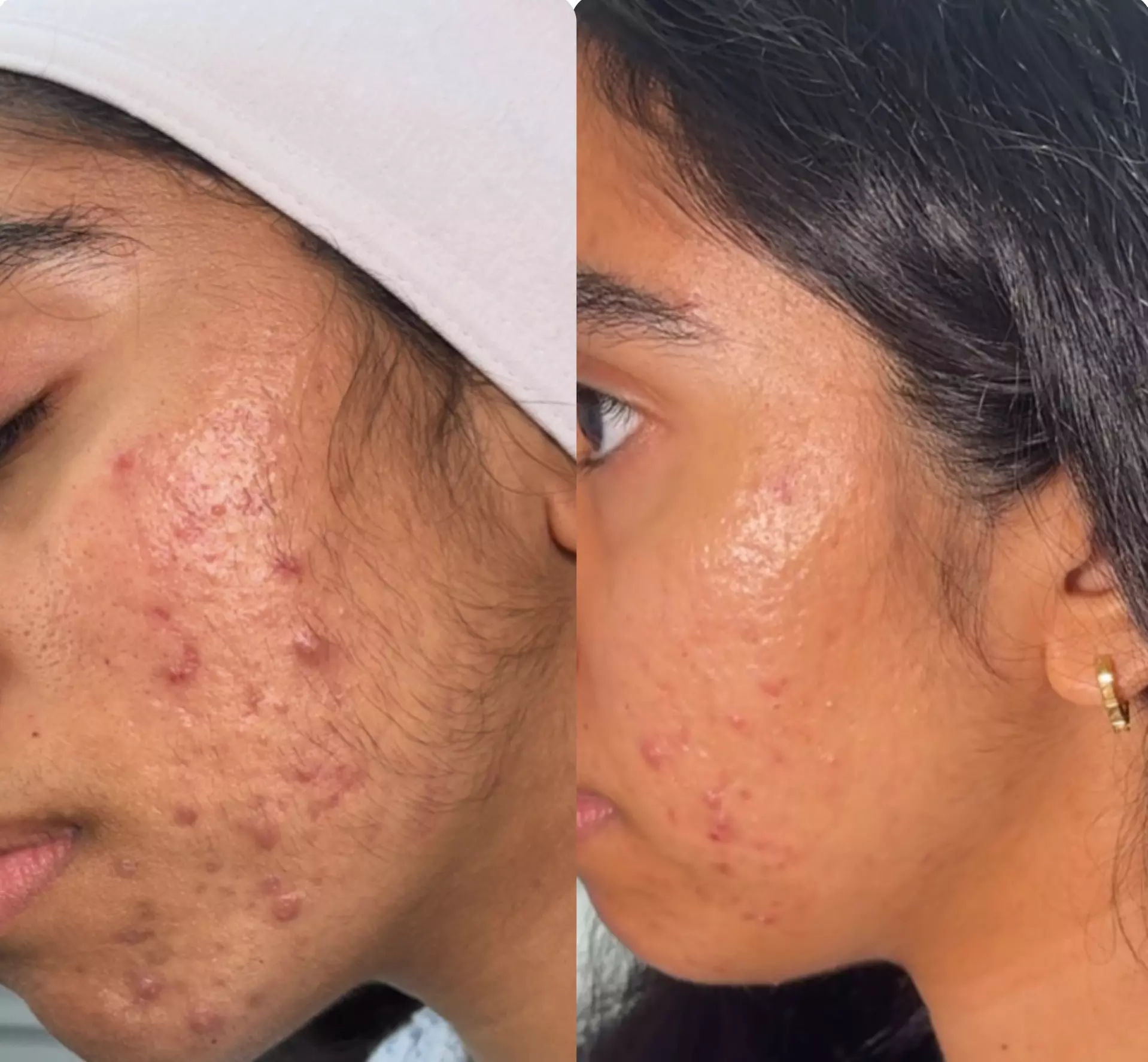 Up to 42% Off on Facial at Everly Happy