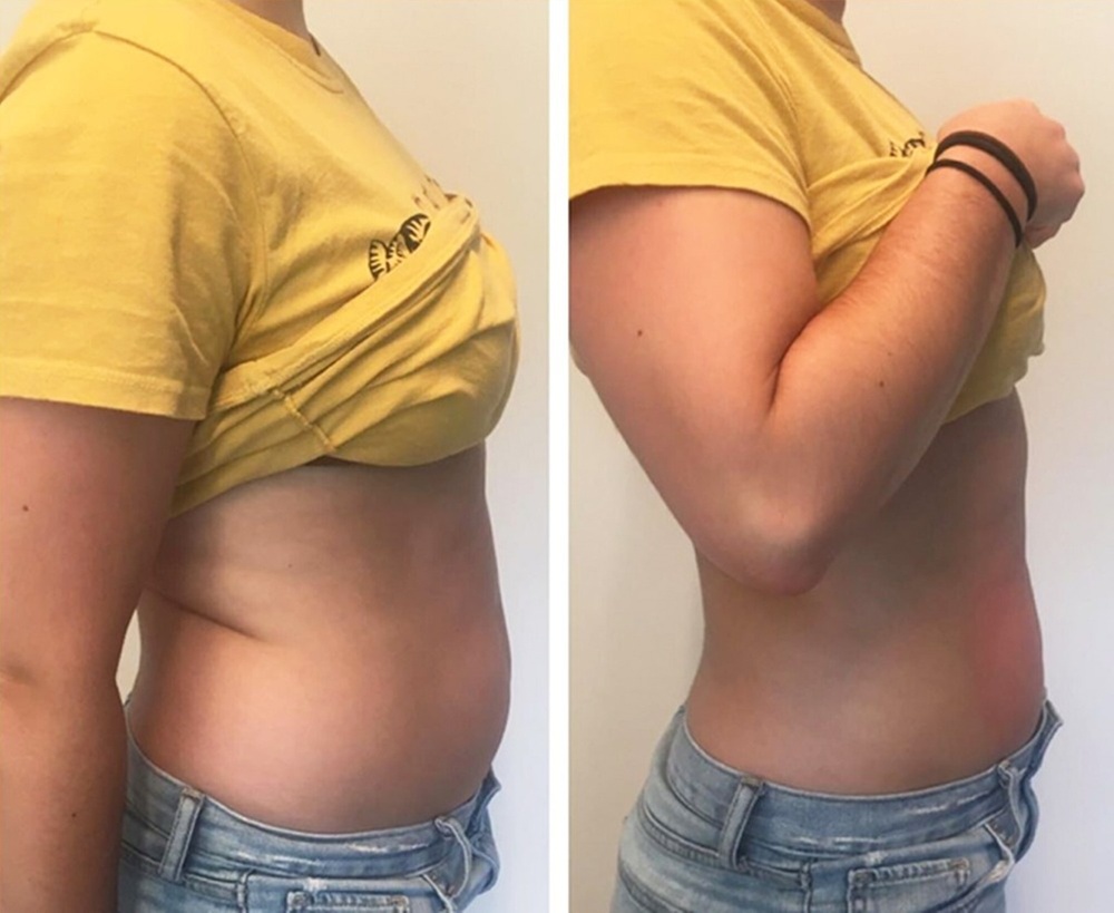 Cryo Liposculpt Intro Sessions for Various Body Areas of Your Choice