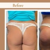 Image 3: Up to 45% Off on Non-Surgical Butt Lift at Double Take Body Studio