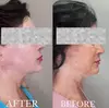 Up to 46% Off: Transform Your Look with HIFU for All Areas at Region Medical Center—Reveal a Youthful Glow!