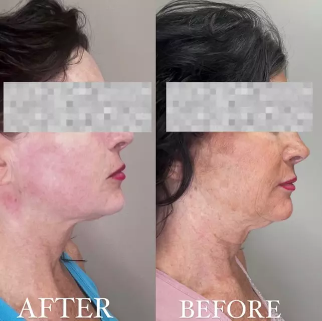 Up to 46% Off: Transform Your Look with HIFU for All Areas at Region Medical Center—Reveal a Youthful Glow! - Primary Image