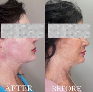 One Ultherapy for Small or Medium Area - Region Beauty and Wellness