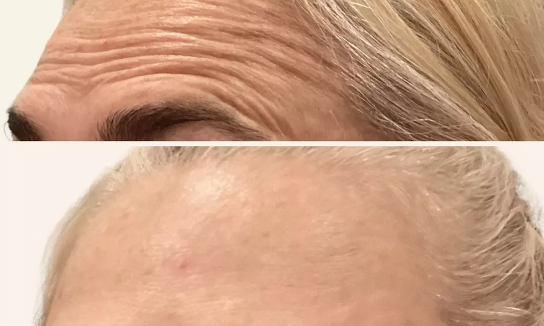 Smooth Your Skin with 20, 40 or 60 Units of Xeomin Injections