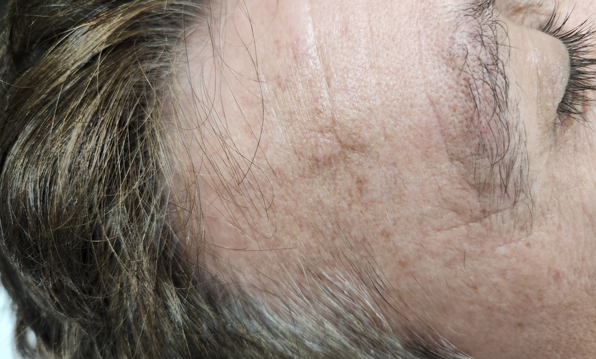 Image 2: Full Face: Co₂ Fractional Laser Treatment at Sydney Plastic Surgery