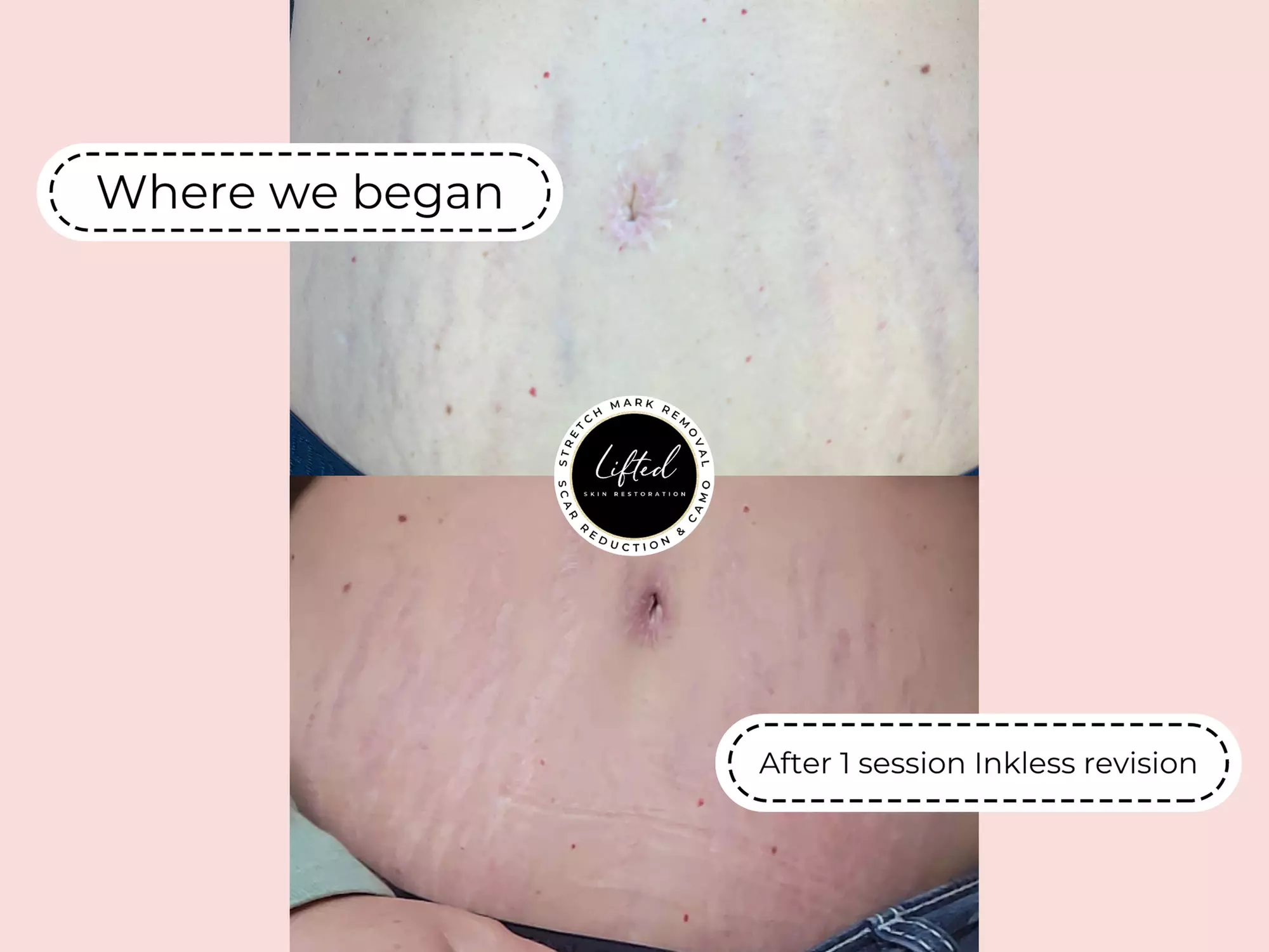 Up to 45% Off on Tattooing at Lifted Skin Restoration - Primary Image