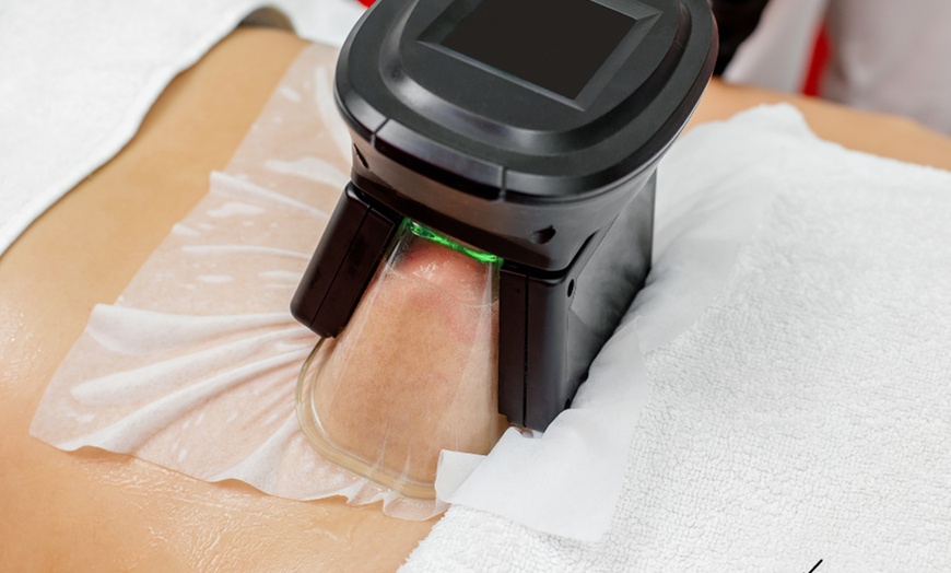Image 2: Do 27% zniżki na Redukcja tłuszczu/cellulitu - niemarkowe w ALKU-MED | Medicine & Cosmetology